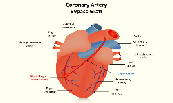 Coronary Artery Bypass Grafting (CABG)