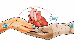 Heart Transplant