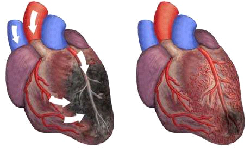 Heart Transplant