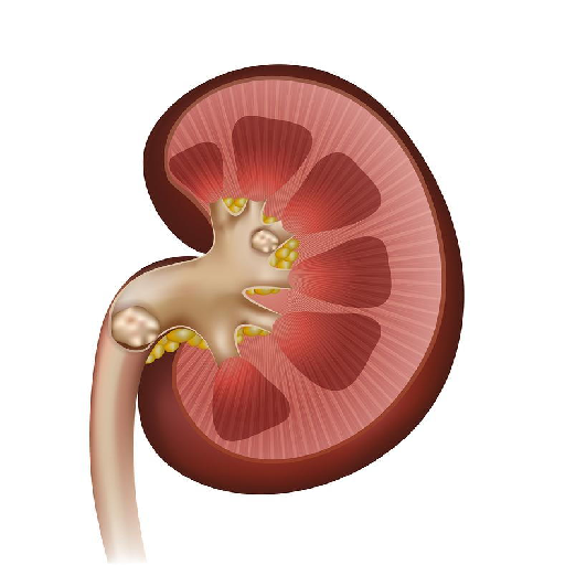 kidney-stone-removal