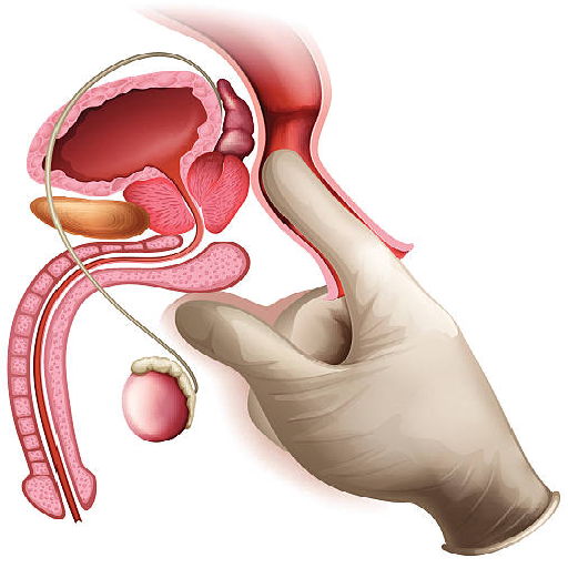 prostate-surgery