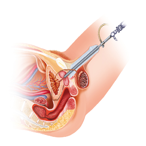 urethral-stricture