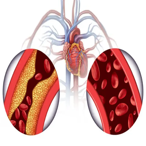 angina-disease