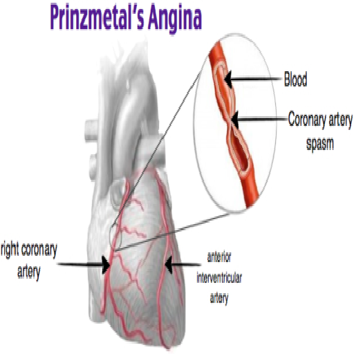 prinzmetal-angina