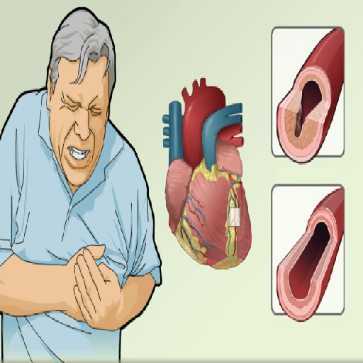 stable-angina