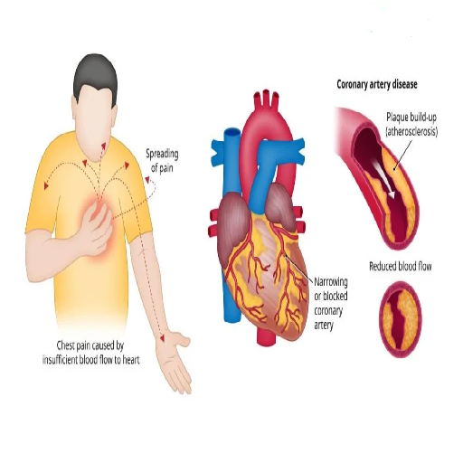 unstable-angina
