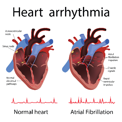 Arrhythmias