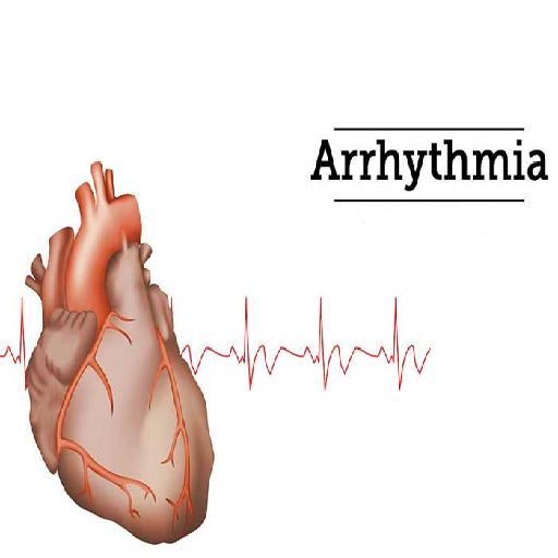 arrhythmia
