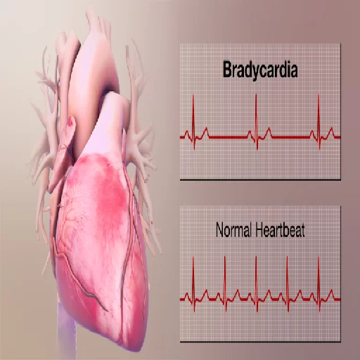 bradycardia