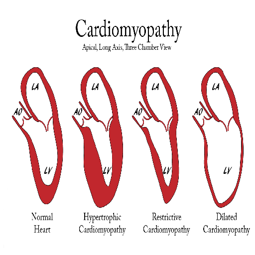 cardiomyopathy