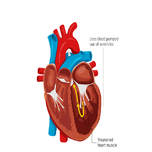 heart-failure
