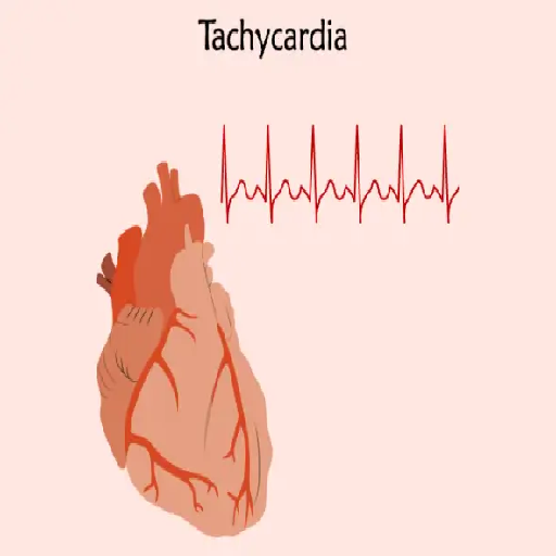 tachycardia