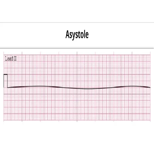 asystole