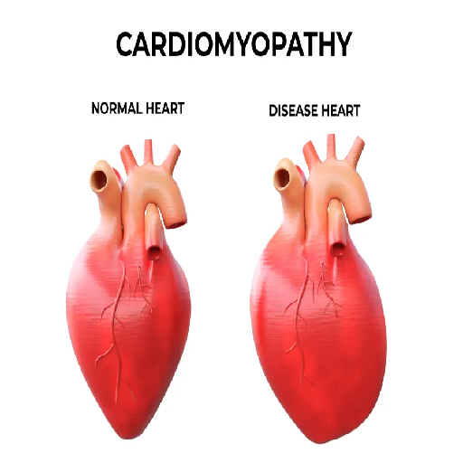 cardiomyopathy