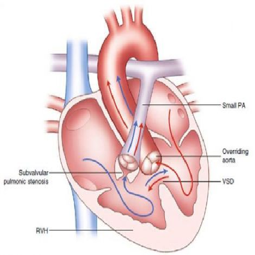 Congenital Heart Defects