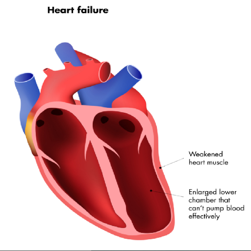 severe-heart-failure