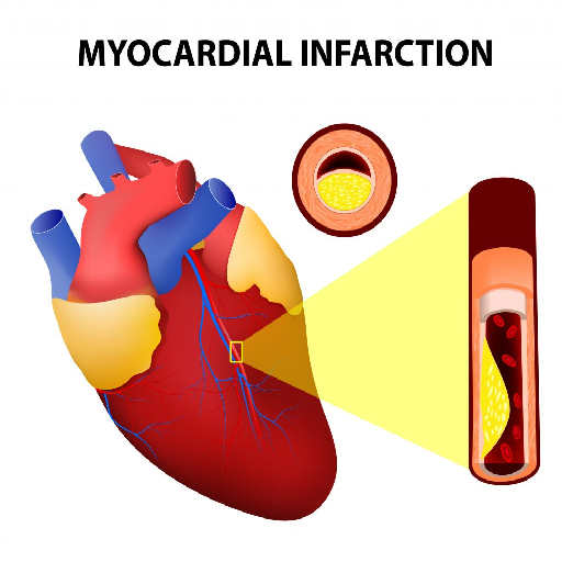 Myocardial Infarction