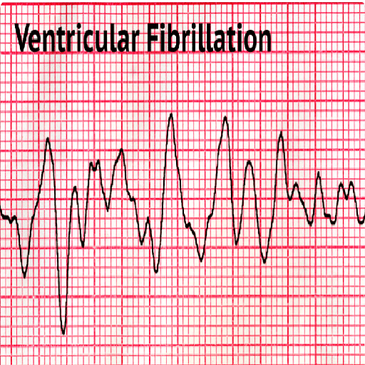 ventricular