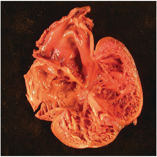 Cardiomyopathies
