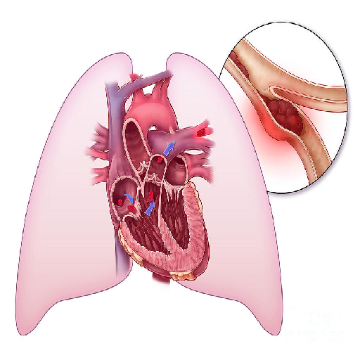 Lung-Related Causes