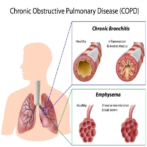 Chronic Dyspnea