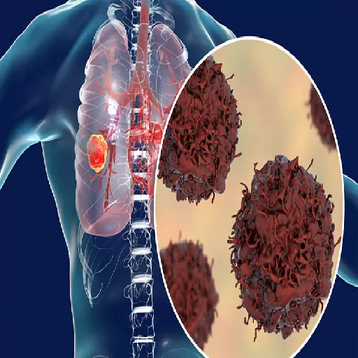 lung-related-disease