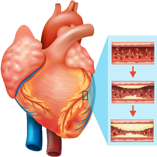 heart-disease