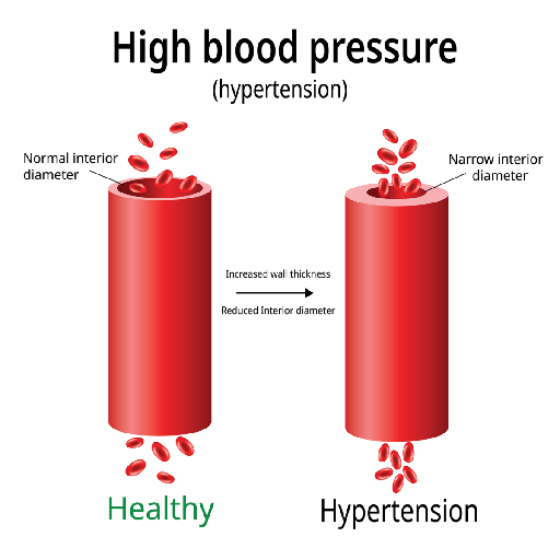 Hypertension