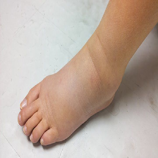 Swelling