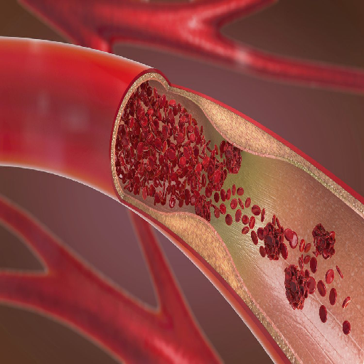 Vascular Diseases