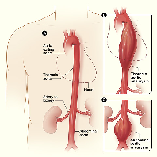 Aneurysm Repair
