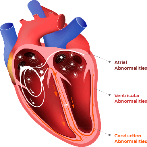 Arrhythmias