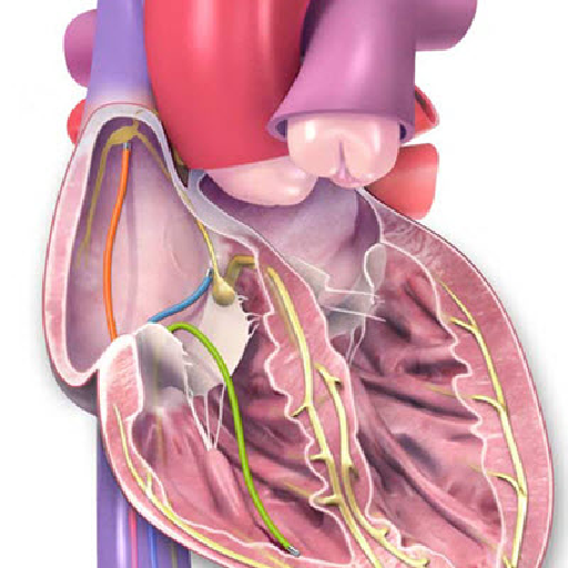 arrhythmia