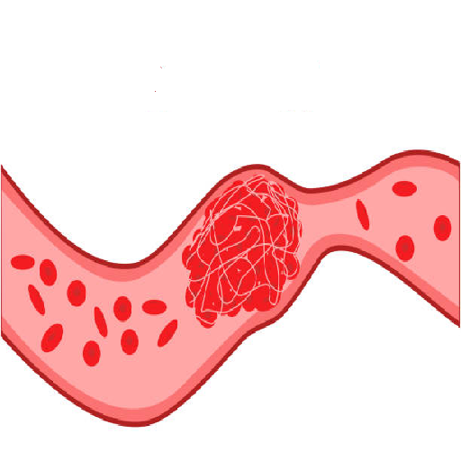 Blood Clots