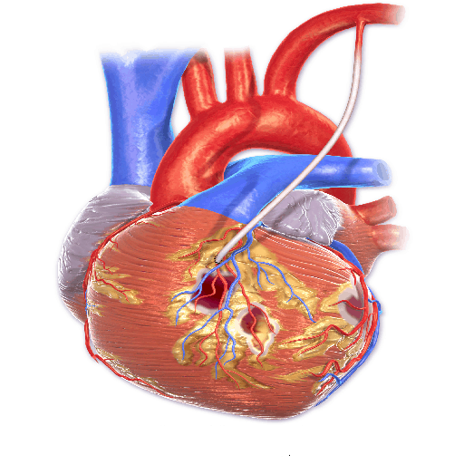 CABG
